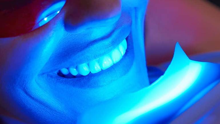 Blanchiment Dentaire - Soin Visage Amandi Nails Le Roeux Mons