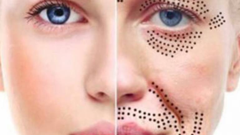 Soin du visage - Plasma Lift par Amandi Nails Le Roeulx