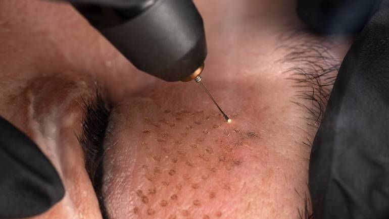 Soin du visage - Plasma Lift par Amandi Nails Le Roeulx